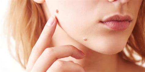 Benign Skin Lesions Lumps And Bumps Laser Skin Sexiz Pix