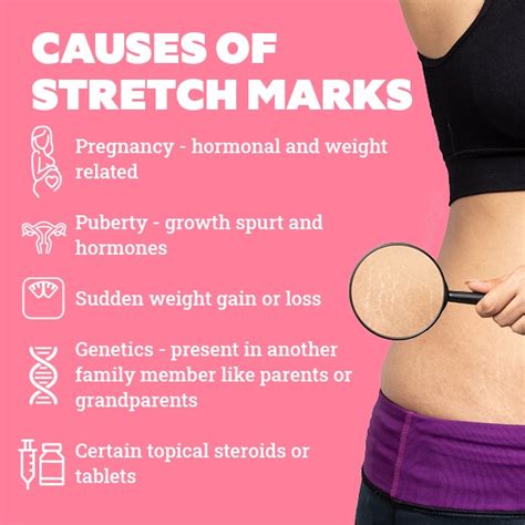 Should Stretch Marks Be Raised