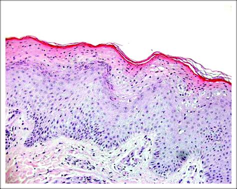 Necrolytic Migratory Erythema Associated With Pancreatic Glucagonoma