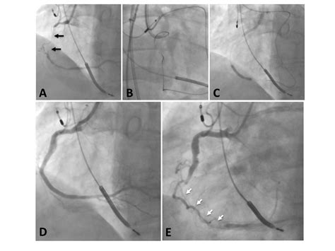 Should Chronic Total Occlusion Be Treated With Coronary Artery Bypass