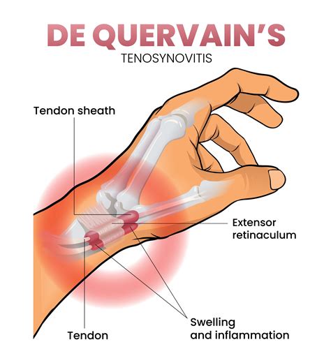 Tenosinovite Di De Quervain Move Therapy Legnano
