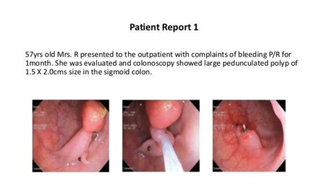Endoscopic Removal Of Colonic Polyps