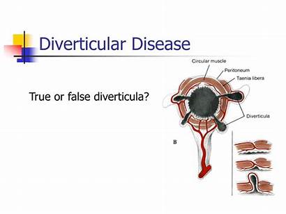 Bowel Basic False True Diverticula Diverticular Disease