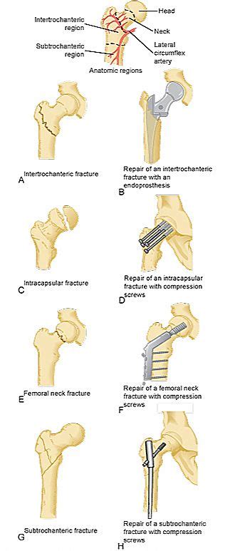 Hip Fractures And Surgical Repairs Orthopedic Nursing Surgical