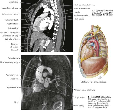 The heart has two receiving chambers, and two pumping chambers. Thorax | Radiology Key