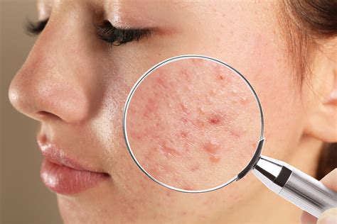 Acne Is One Of The Most Common Skin Problems Discover How To Treat It
