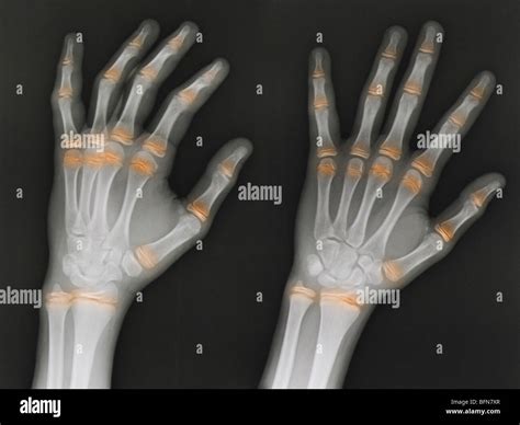 Hand X Ray 12 Year Old Male Two Views With The Epiphyseal Growth