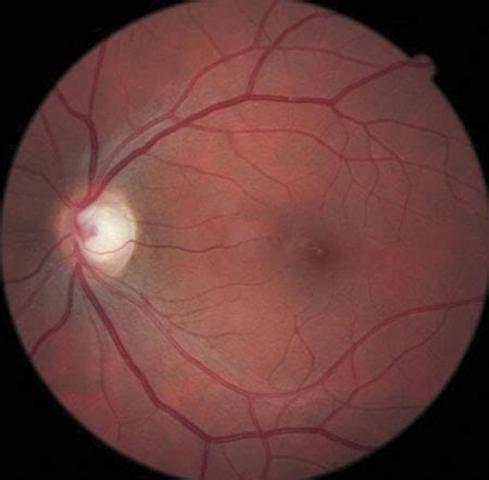 Glaucoma Suspect Shows Subtle Retinal Nerve Fiber Layer Thinning