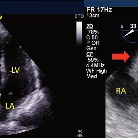 Patent Foramen Ovale Pfo With Thrombus In Transit Intraoperative