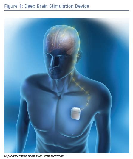 Deep Brain Stimulation Device Radcliffe Cardiology