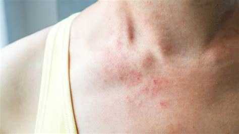 How To Control An Eczema Flare Up In Summer
