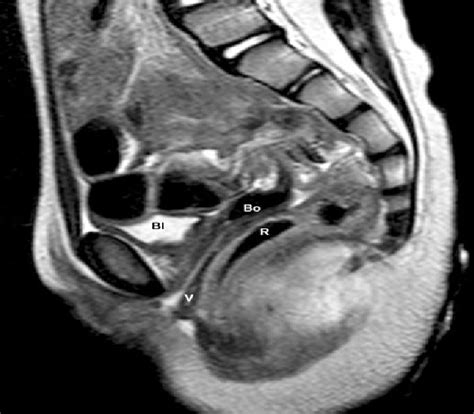 Figure 2 From Mayer Rokitansky Küster Hauser Syndrome Associated With A