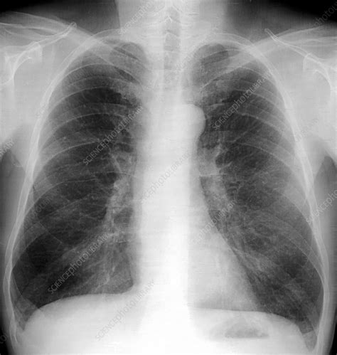 smoker s lungs x ray stock image c001 7637 science photo library