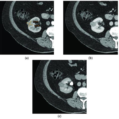 The Accuracy Of Radiological Small Renal Mass Srm Type Diagnosis And