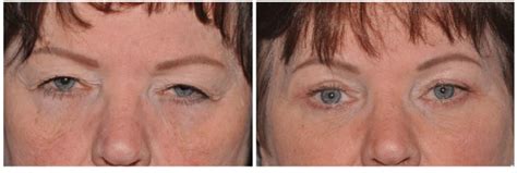 Before And After Gallery Oculofacial Eyelid Surgery Before And After
