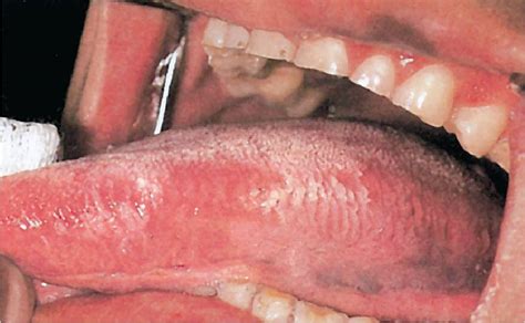 Tongue Discoloration And Surface Changes Visual Diagnosis And