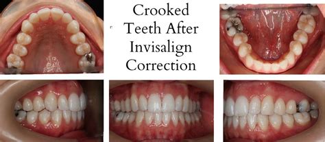 Crooked Teeth Before And After Invisalign Goimages Eo