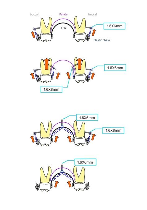 Methods Of Molar Intrusion With Tads In The Maxilla Download Scientific Diagram