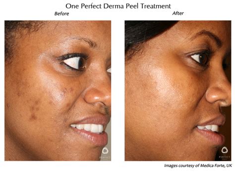 Perfect Derma Peel Medical Aesthetic Devices