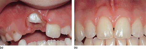 Eruption And Shedding Of Teeth Pediatric Dentistry A Clinical