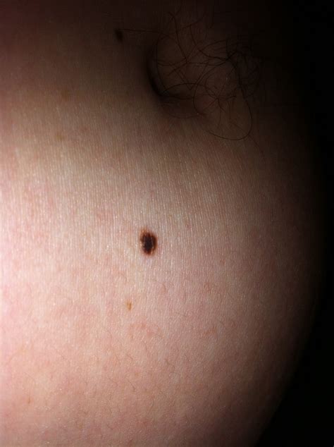 Hi I Have For At Least 4 Years Had This Dark Mole On My