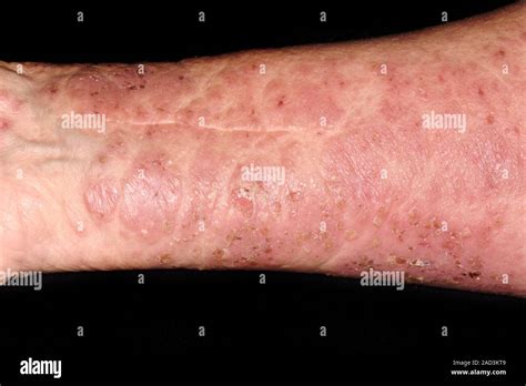 Bullous Pemphigoid Close Up Of A Rash On The Arm Of An 80 Year Old