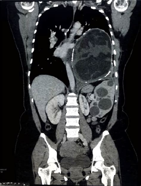 Coronal View Of Ct Scan Of The Chestabdomenpelvis