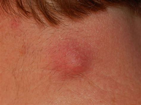 Lump On Neck Causes And Pictures