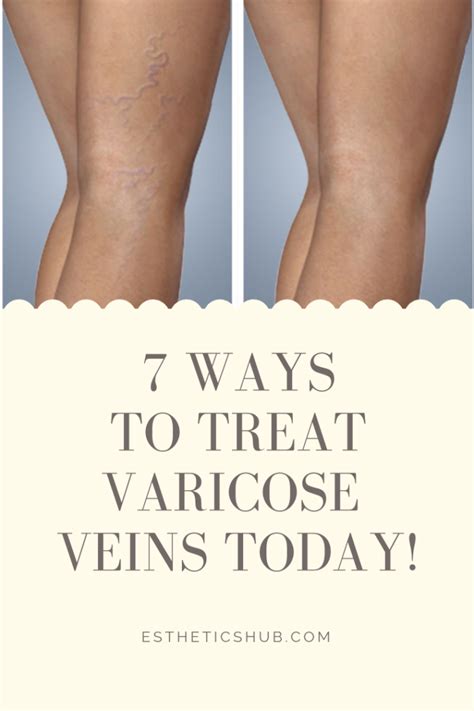7 Ways To Prevent And Treat Varicose Veins Estheticshub