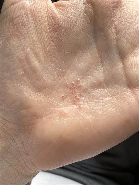 An Entire Year Apart Round Of Scabies Concentrated On My Palm This