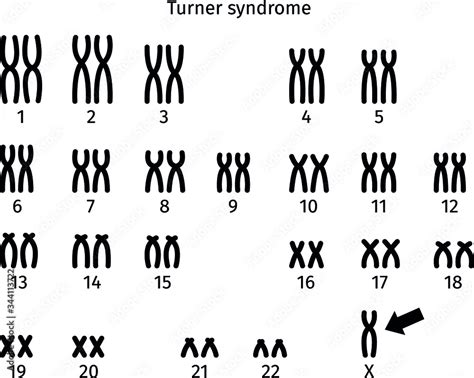 Scheme Of Turner Syndrome Karyotype Of Human Somatic Cell X Stock