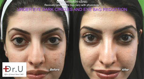 Video Dark Circles And Eye Bags Non Surgical Eye Bag Reduction