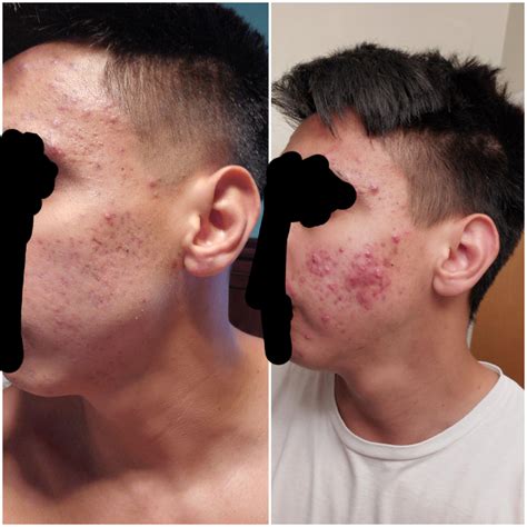 Acne Finally Clearing Up At 25 Years Old So Went To A Dermatologist