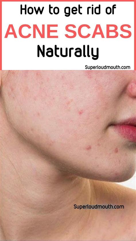 40 Best Ways To Get Rid Of Acne Scabs Overnight Diy Home Remedies