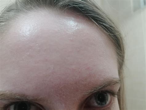 Skin Concern How Do I Get Rid Of These Babe Bumps On My Forehead R Rosacea
