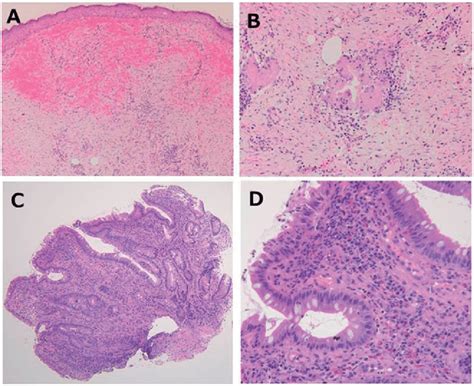Histopathological Findings Of Skin And Ileal Pouch A Skin Biopsies