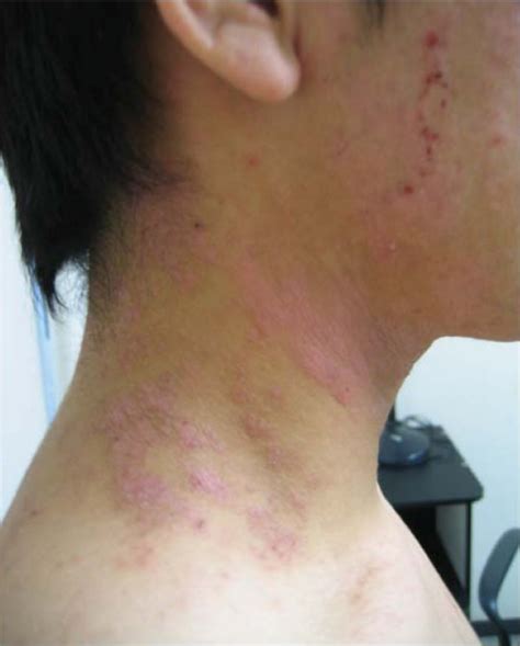 Eczema On The Patients Neck Photographed On Day 5 Download