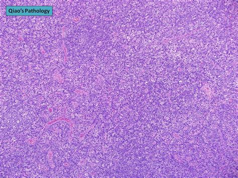 All Sizes Qiaos Pathology Reactive Lymphoid Hyperplasia Flickr