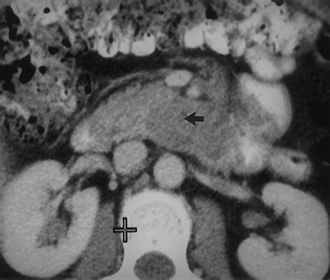 Ct Of The Duodenum An Overlooked Segment Gets Its Due Radiographics