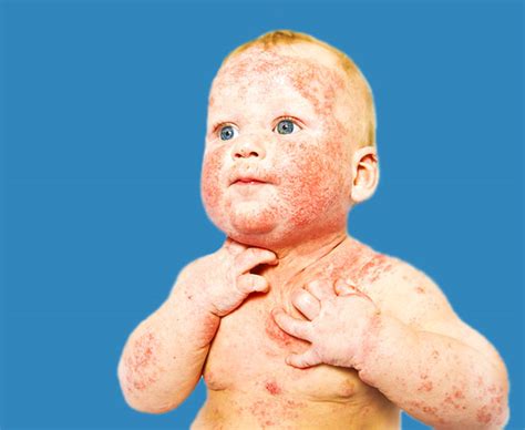 Atopic Dermatitis Causes And Treatment