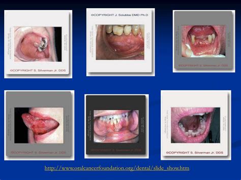 Ppt Oral Cancer Powerpoint Presentation Free Download Id5436550