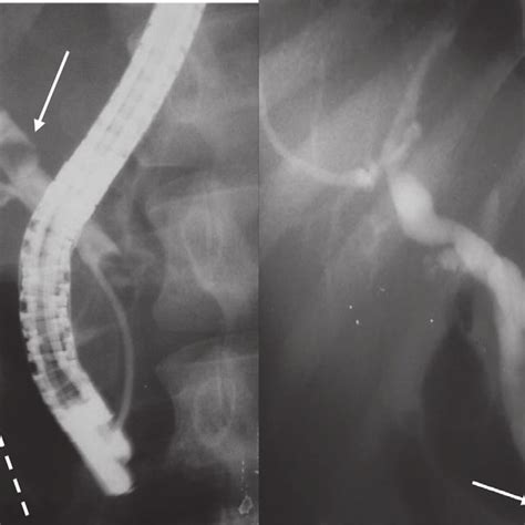 Ercp Showing Dilated Bile Ducts With Stones In Two Different Patients