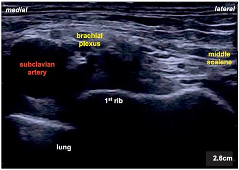 Ultrasound Guided Interscalene And Supraclavicular Brachial Plexus