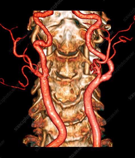 Carotid Artery Disease 3D CT Angiogram Stock Image C033 7382