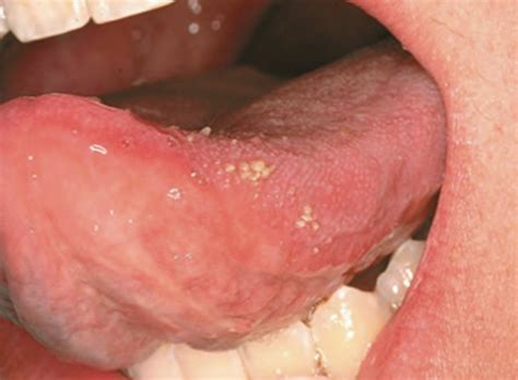 Transient Lingual Papillitis Causes Treatment Pictures