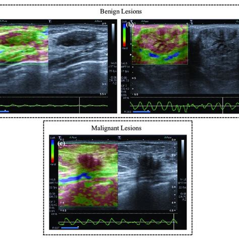 Strain Elastography Measures Tissue Displacement As A Consequence Of An