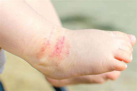 Dermatite Atópica Em Bebês E Crianças Os Sinais E O Tratamento Bebe