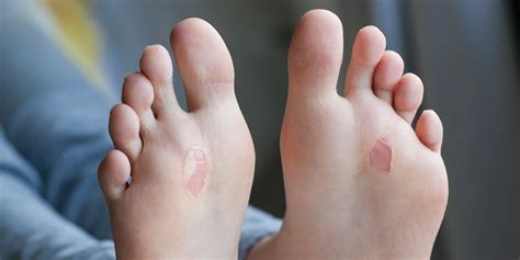 Blisters Benenati Foot And Ankle Care Centers