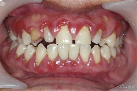 Signs And Symptoms Of A Gum Disease Revealed Diy Health Do It