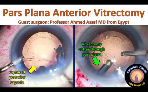 Pars Plana Anterior Vitrectomy Can Be Very Helpful Cataract Coach